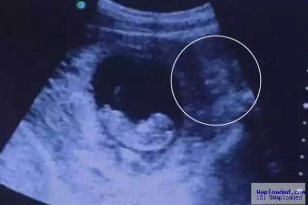 Photo Of Demon Watching Over Unborn Baby In Ultrasound Scan Wents Viral
